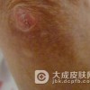 硬皮病的发病前期表现