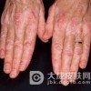 硬皮病的病症之心脏表现