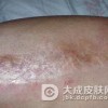 硬皮病发病后会有何症状