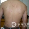 治疗黄瘤病先要降血脂