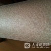 鱼鳞病发病的原因有哪些呢?