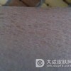 得了鱼鳞病应该特别注意什么