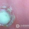 脚上鸡眼怎么治