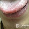 男性尖锐湿疣危害大吗