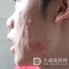 痤疮该如何治疗好呢