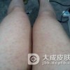 过敏性紫癜患者需要做哪些检查