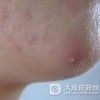 女性痤疮的治疗要点
