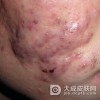 为什么自己患上痤疮呢