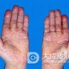 黄瘤病的病理变化有哪些