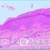 黄瘤病的分类是什么
