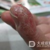 皮炎拉低颜值，怎么治疗