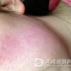 皮炎的治疗护理方法到底有哪些呢