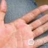 水疱型手癣是什么样的疾病