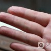 冬天发生了手足皲裂应该怎么办