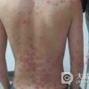 红斑狼疮是什么原因造成的