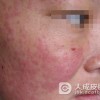 红斑狼疮饮食禁忌