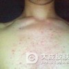 患上青春痘会伴有哪些危害？