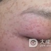 脸上青春痘怎么护理