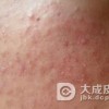 护理青春痘的方法