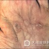 梅毒患者注意事项有哪些