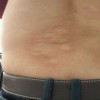 寻麻疹的治疗方法有什么？