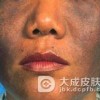 黑变病都有哪些的病因