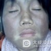 皮肤黑变病的精神因素的分析