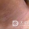 黑变病的发生的原因及发病特点