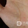 寻常疣对患者危害有哪些
