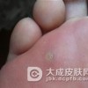 寻常疣治疗过程中要注意什么