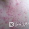 女性患红斑狼疮是什么原因