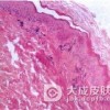 肠病性肢端皮炎护理的措施