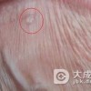 淋病要怎么有效预防