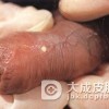 哪些因素导致了淋病的发作