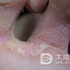 脚气的治疗误区有哪些呢