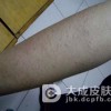 荨麻疹会有后遗症吗