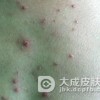 血清病性荨麻疹指的是什么病啊