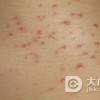 毛囊炎患者应该怎样护理