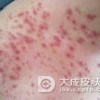 毛囊炎患者的护理事项