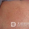 得药疹的病后能不能使用肥皂