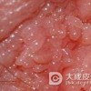 女性尖锐湿疣发病后的症状有哪些