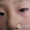 怎样避免接触性皮炎的发生
