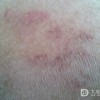 春天需注意预防接触性皮炎