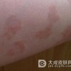 牛皮癣不断恶化该怎么办呢