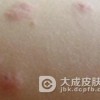 自体敏感性皮炎诱发的原因都是什么