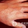 自身敏感性皮炎是如何的出现的