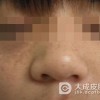 防治雀斑的措施有哪些？
