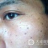 预防遗传性雀斑有哪些注意事项