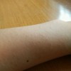 急性荨麻疹和潮湿有关系吗