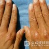 皮肌炎该如何护理呢